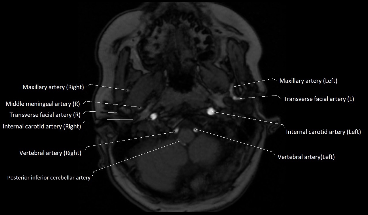 Carotid artery anatomy axial 3T image 3.jpg